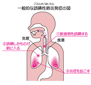 一般的な誤燕性肺炎発症の図