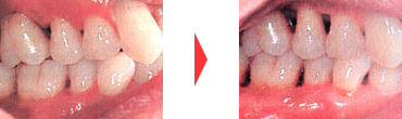 歯周病治療・歯周病の予防