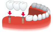 人工歯根インプラント治療システム イメージ