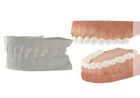 1.歯型採取と模型製作